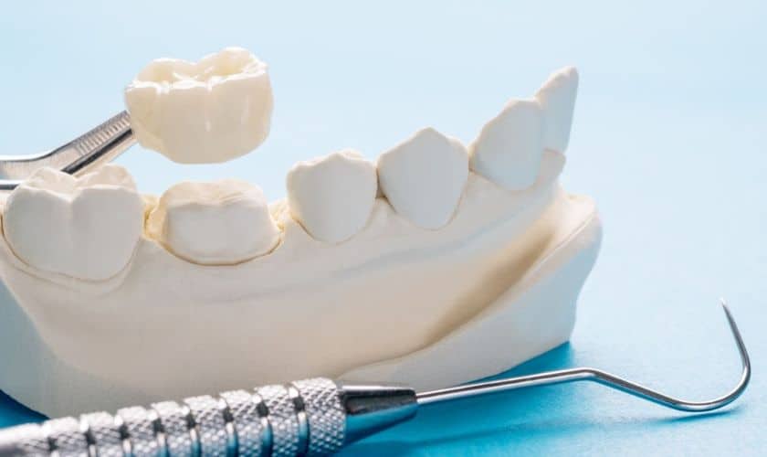 Dental-Crowns