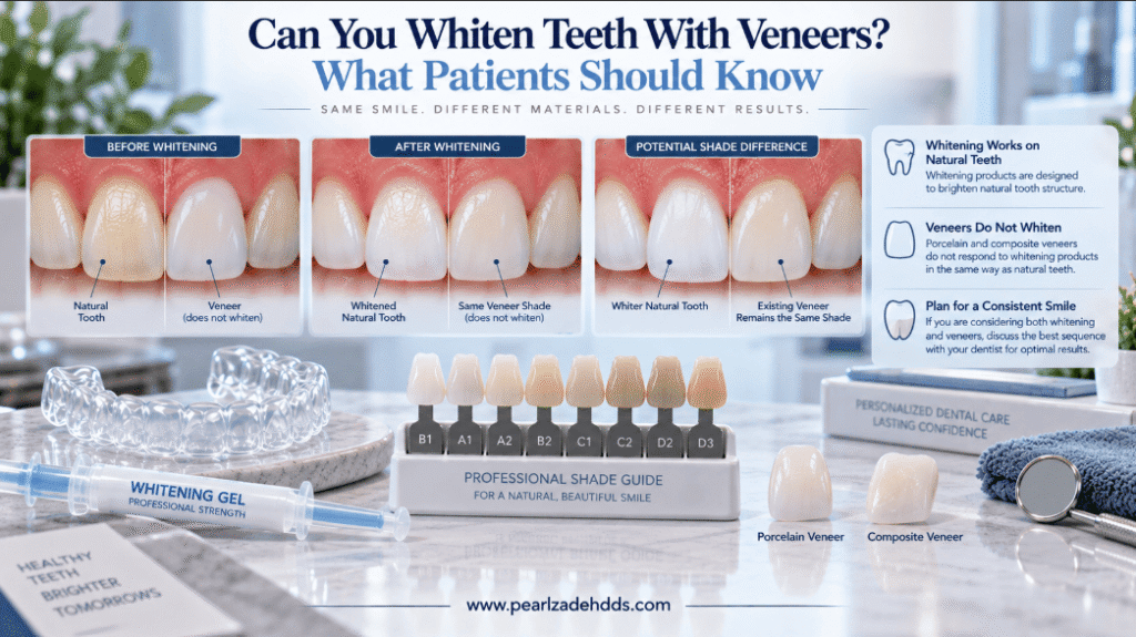 Can You Whiten Teeth With Veneers