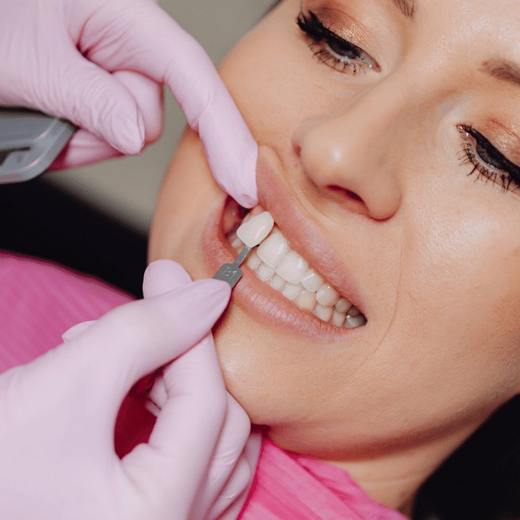 Composite veneers