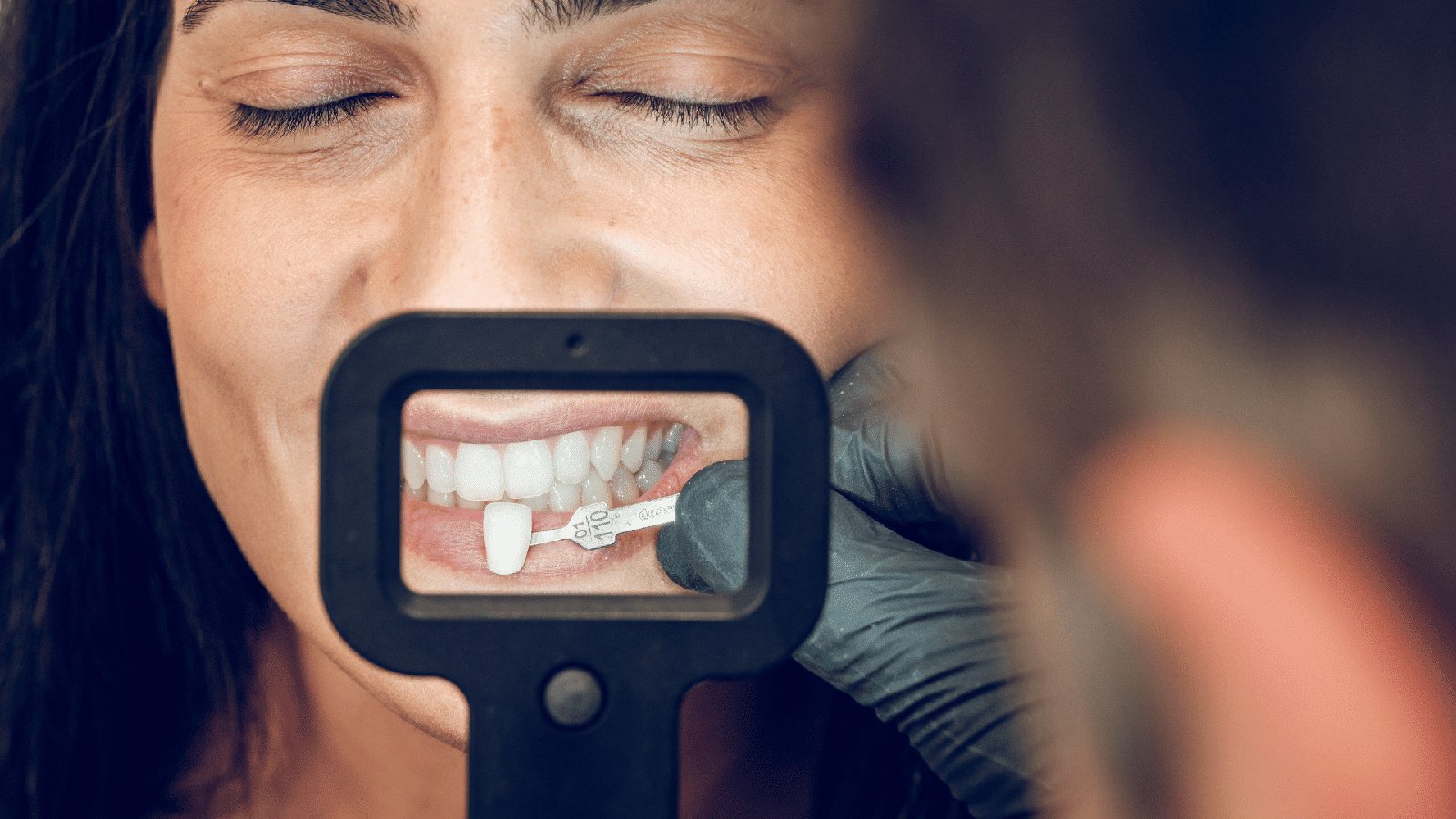 composite veneers image