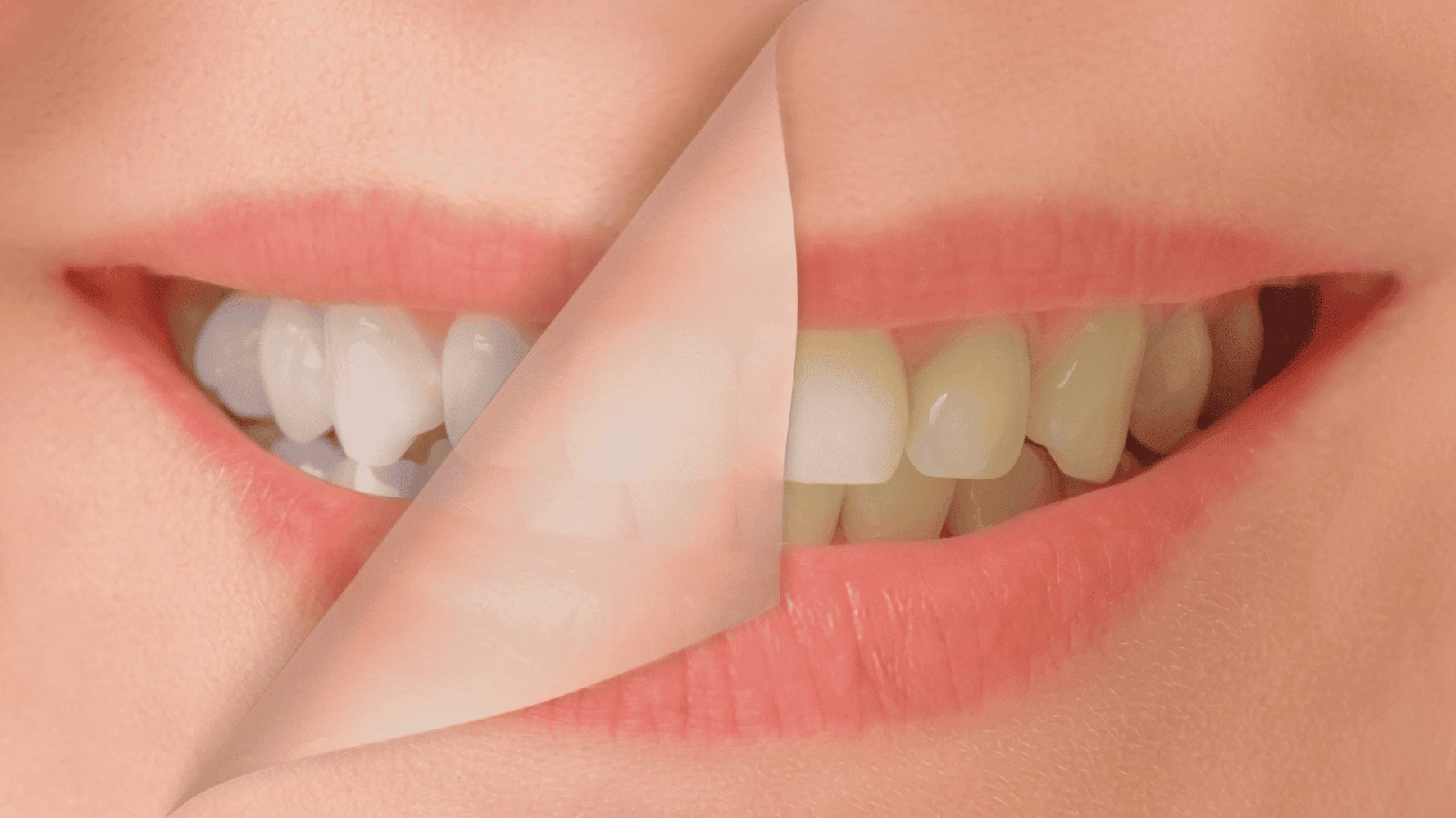 Teeth whitening image