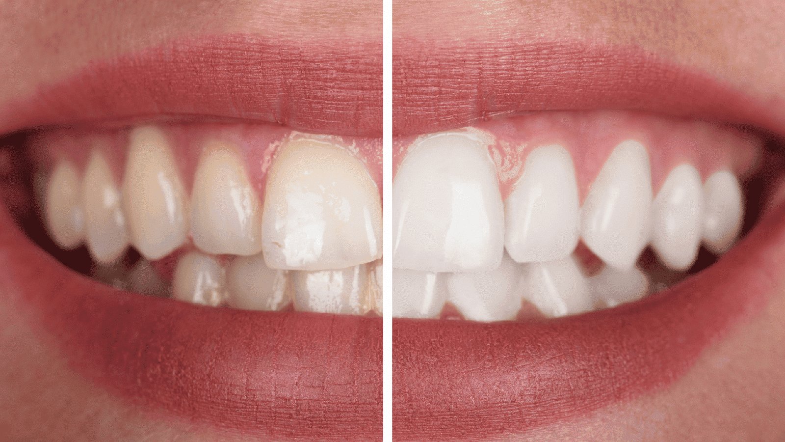 teeth whitening image
