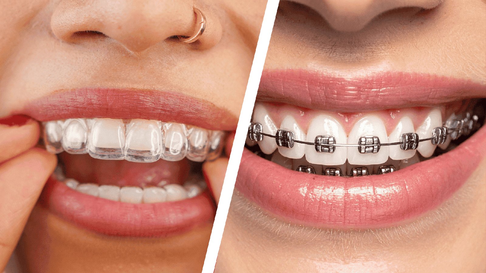 Invisalign vs Traditional Braces