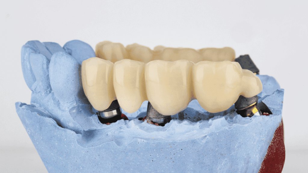 Porcelain Bridges