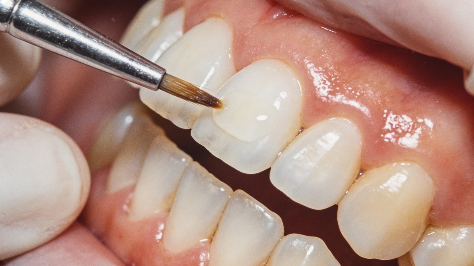 porcelain veneers