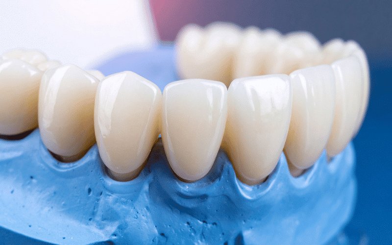 porcelain bridges Image