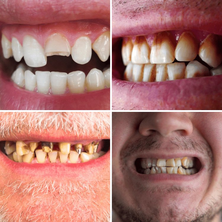who needs dental veneers