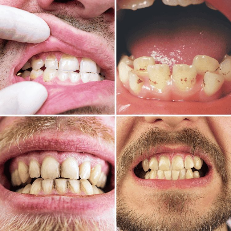 Dental Veneers