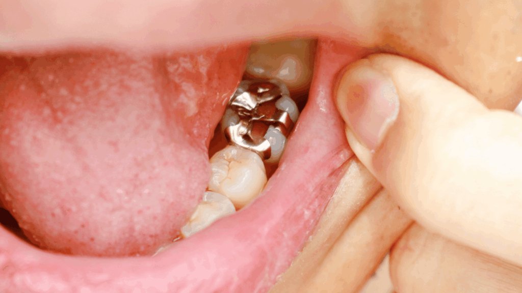 Should You Replace Old Silver Fillings Even If They Don’t Hurt