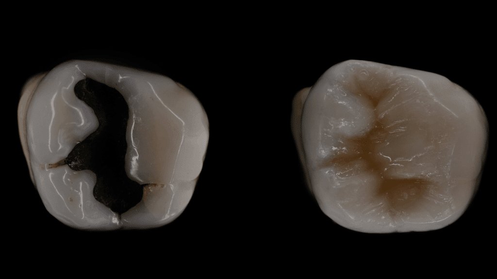 Side Effects of Mercury Filling Removal