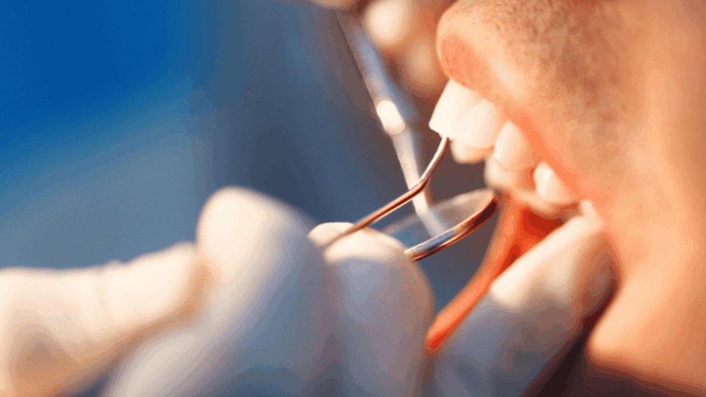 What to Do If a Composite Filling Falls Out
